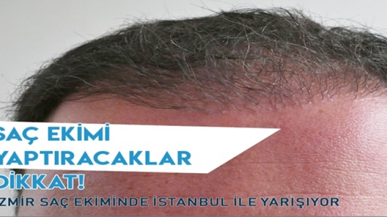 İzmir Saç Ekiminde İstanbul İle Yarışıyor